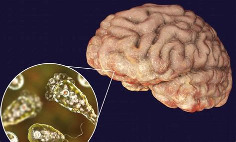 Naegleria Fowleri: Unraveling the Mysteries of This Brain-Eating Amoeba Found Lurking in Warm Waters!